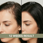 12-week visible hair density results: Before and After using Masil Hair Density Serum.